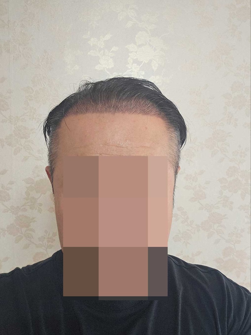 수술후 2주정도.jpg