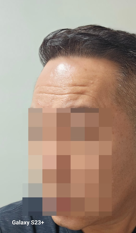 다나성형외과 비절개모발이식 6000모 13개월 ^^