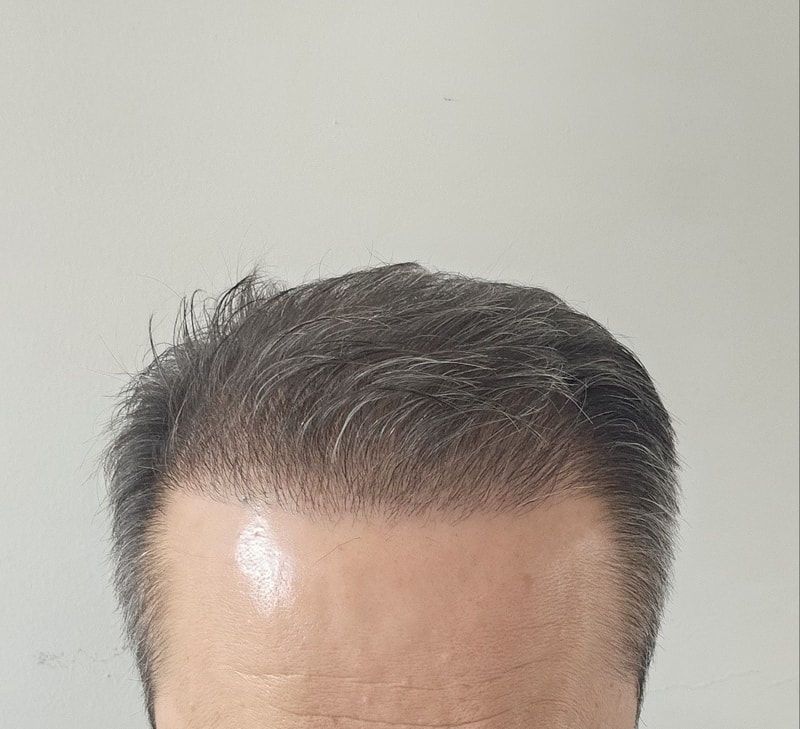 수술후4달정면.jpg