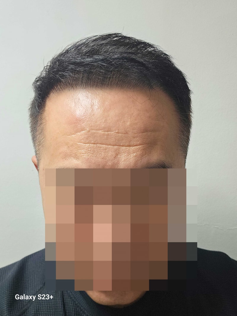 모발이식을 완료하였습니다.jpg