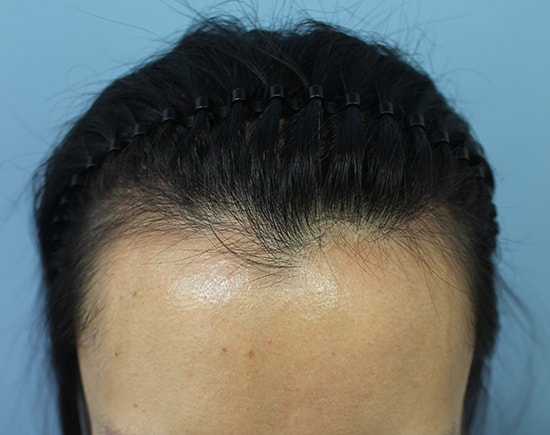 長く悩んで悩んでヘアラインをしました