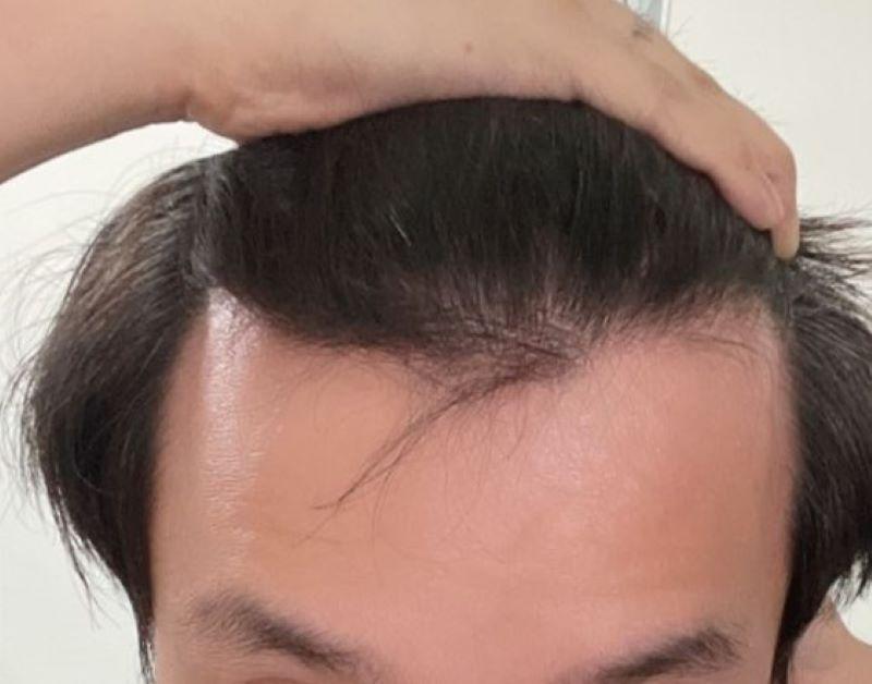 학부모 모임도 자신있게 갑니다 압구정 포헤어 비절개슬릿 모발이식 10개월 후기