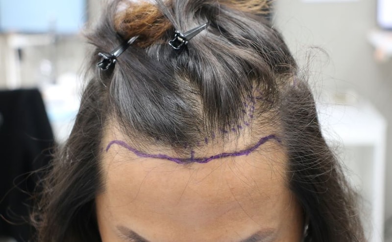 I had a non-cutaneous hair transplant, M.V. transplant