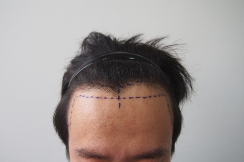 Immediately after the maternal non-cut 1500 hair follicle surgery ~ 10th day late