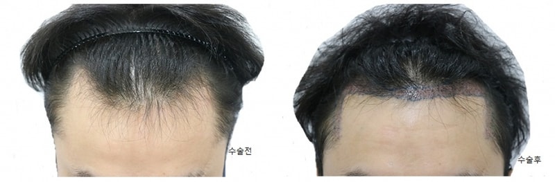 This is a review of 3,000 hair transplantation in a non-cut two-block cut.