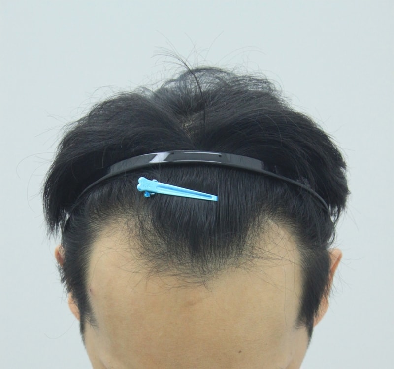 FORHAIR 1300毛囊 20多天