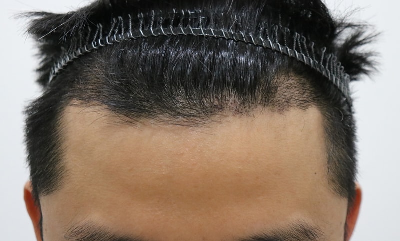 Emza top of my head transplant is 2 weeks non-smoking..