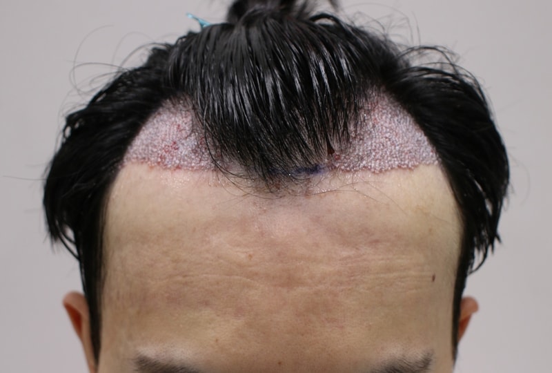 02.이식후.JPG