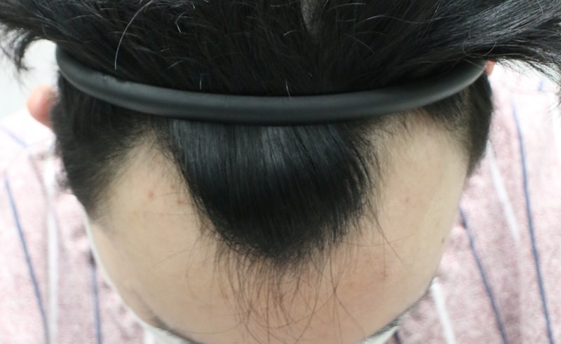 04.수술전.JPG
