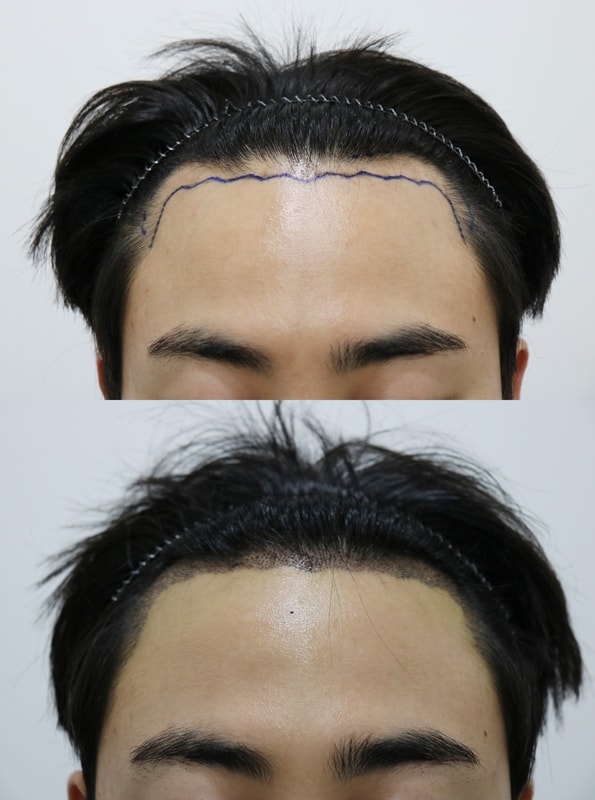 현상유지 정도라 모발이식했어요 ㅋ