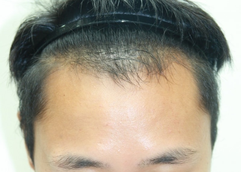 釜山フォーヘアM字脱毛手術後のレビュー(剃髪)