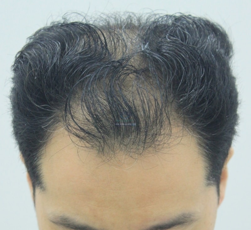 It's been about three and a half months since the hair was 2500 hair follicles.