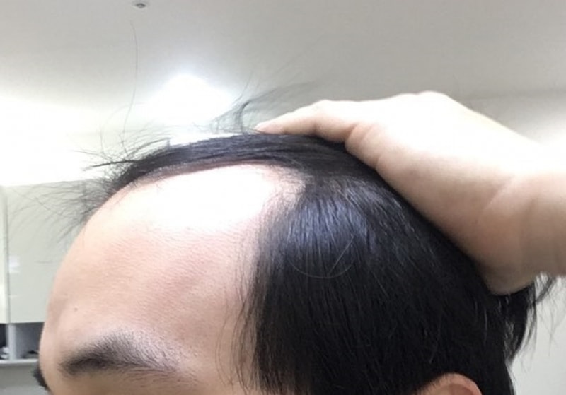 M字型 1300毛包 雨切り ポヘアでやりました