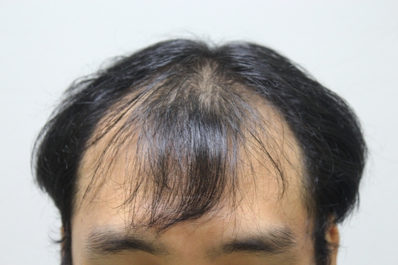 예비신랑 대구 포헤어 2200모낭 후기