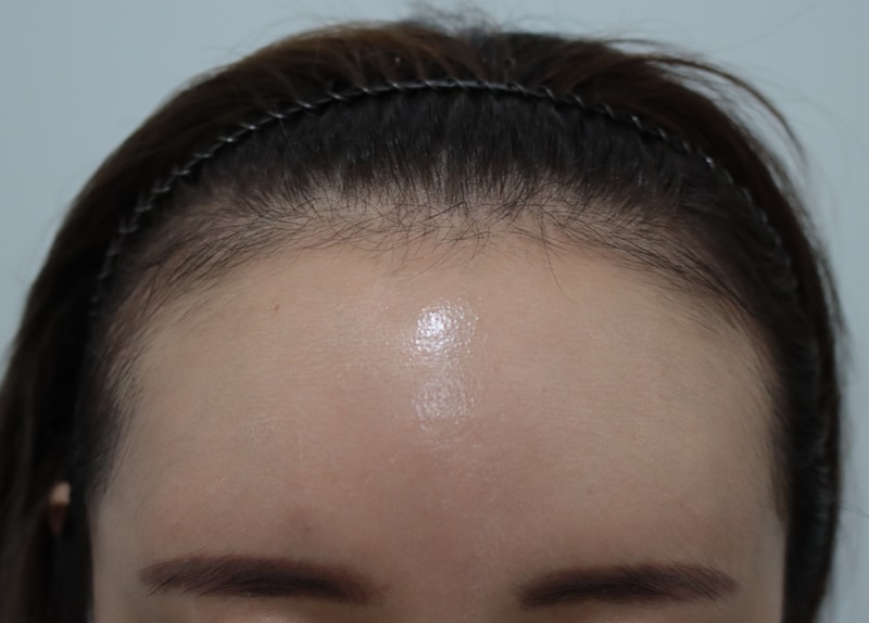 It's been a month since I had a hair transplant