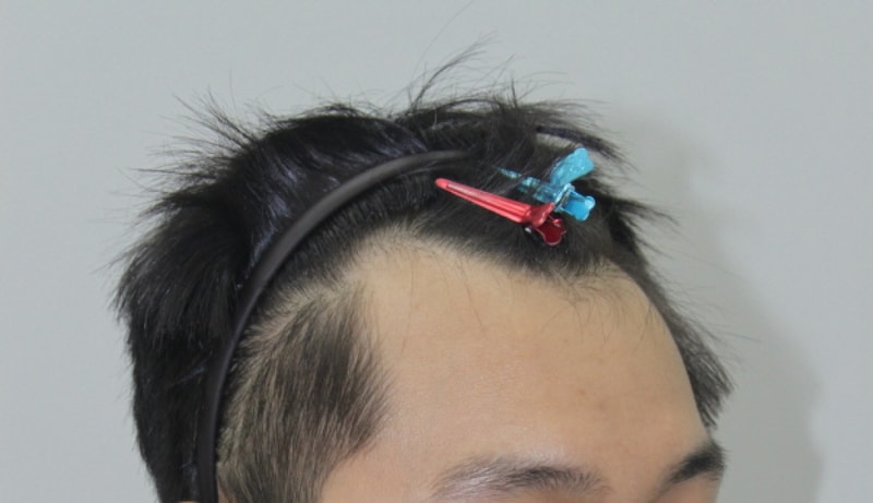 크기변환_수술전_우.jpg