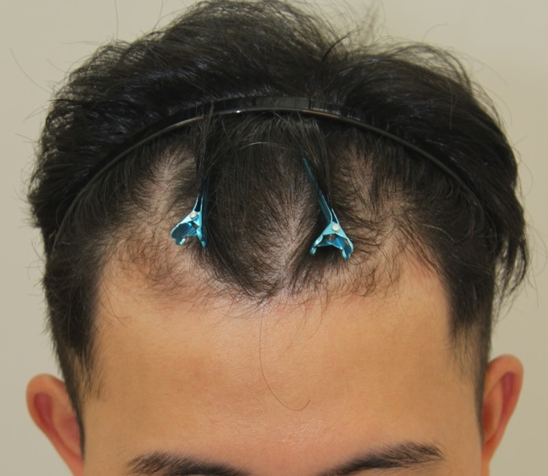 1200 follicle line successful in forehair