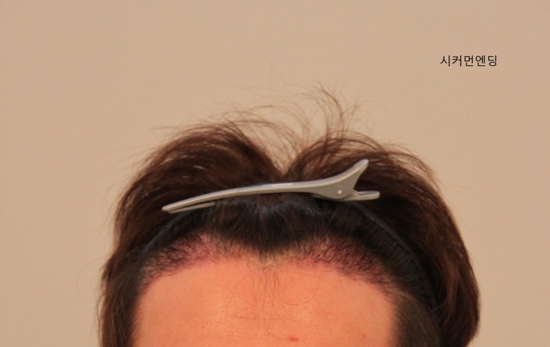 Photos of the 3rd week of 1200 hair follicles + what you feel + know-how