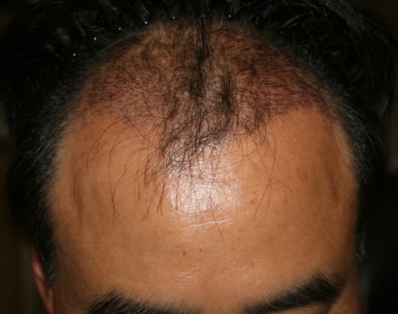 釜山FORHAIR毛发移植的第二个后记