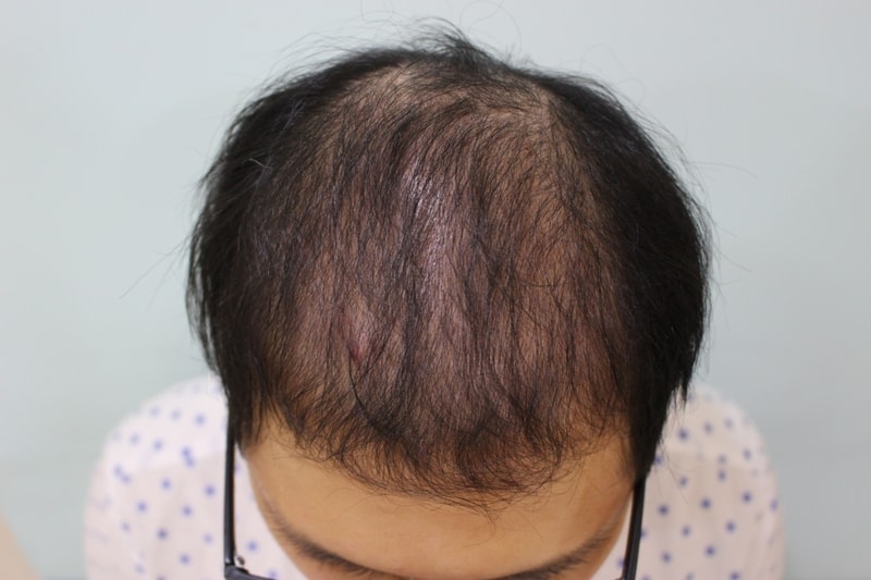 ㅊC ㅌ incision 3800 Mo is 3 months late.