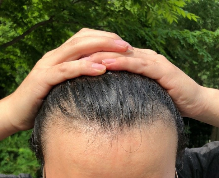 ダナロングヘアの手術直後