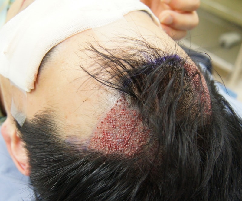 Motion!!! Report on the 7th day of 800 hair follicle-free foot