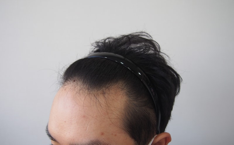 수술 전 좌측.JPG