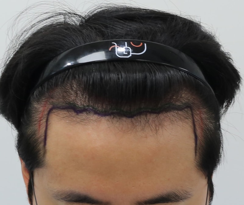 수술전.jpg