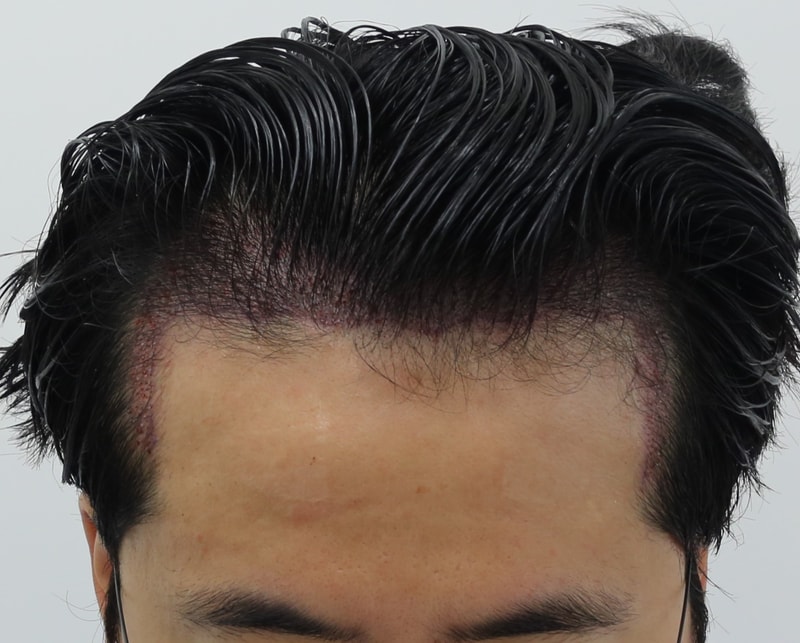 이식후.jpg