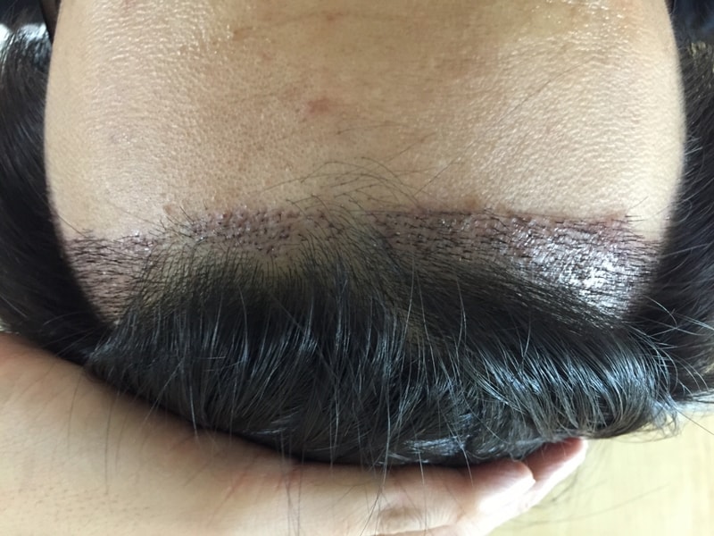 Remove the second week of hair transplant (with photo)