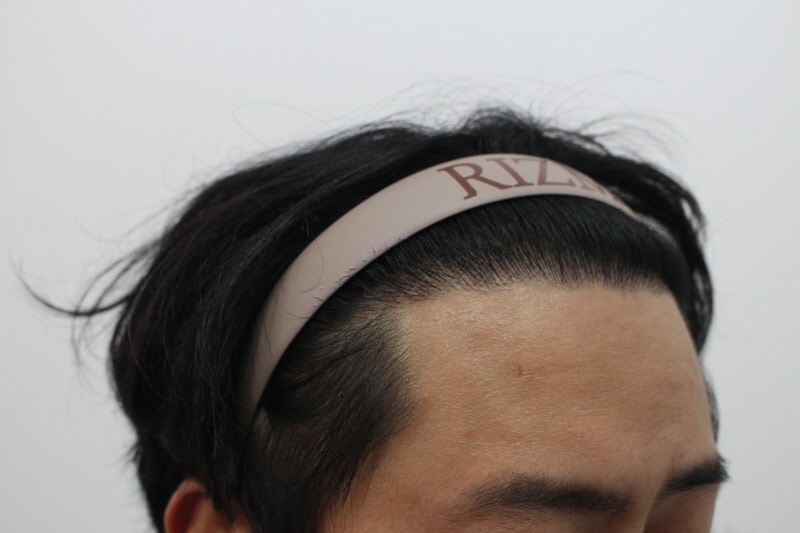 [크기변환]수술후 8개월차 측면3.jpg