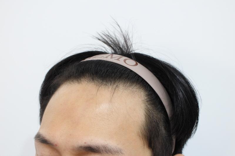 1. 수술전 옆모습 .jpg