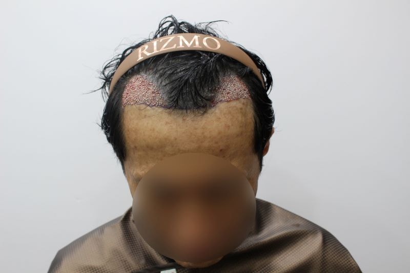 4.수술받고난 직후인데 왜 벌써 엠자 탈모가 없어진거 같고 좋은지 너무 기쁩니다..jpg