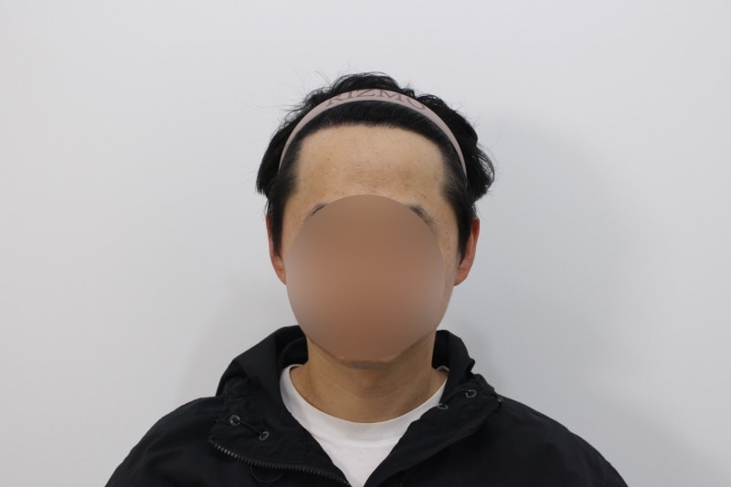 수술하고나서 12개월차.jpg