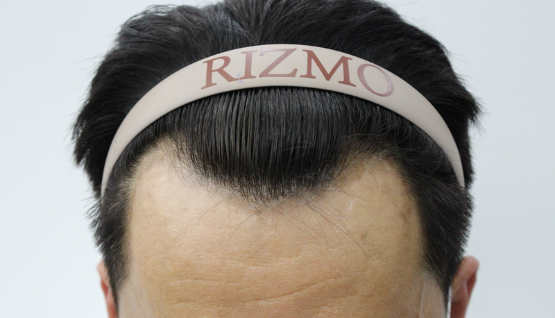 This is the review of the day of the 1800 hair incision hair transplant.