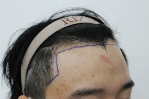 [Busan Lizmo] M-shaped hair loss in 20s, a year review
