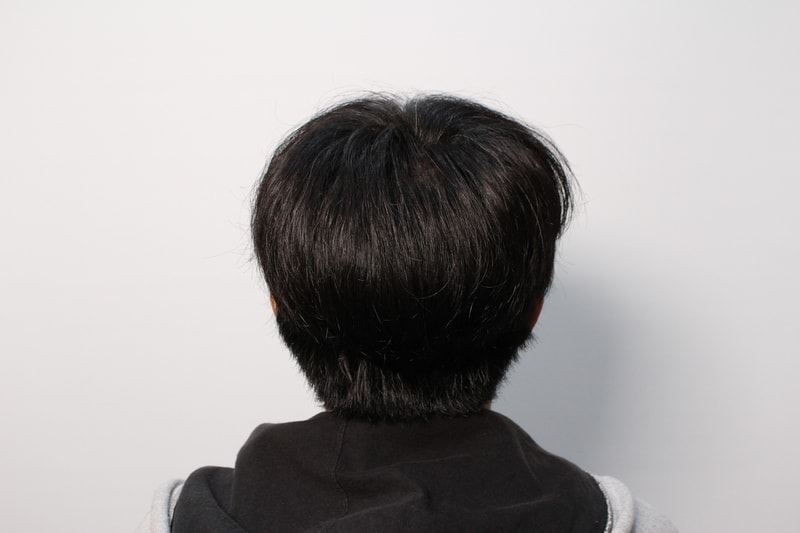 4.후두부도 수술하고도 티 않나게 잘해주셨습니다..jpg