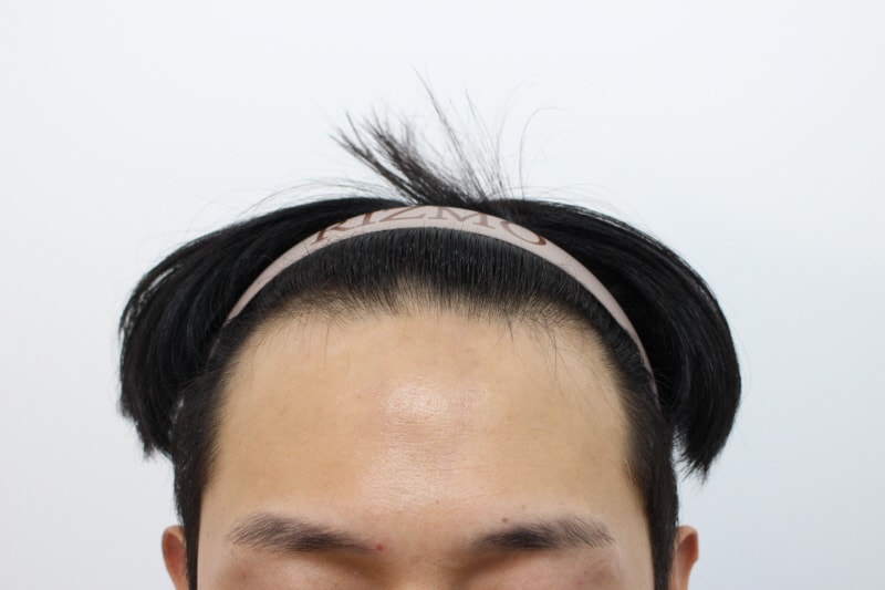 4.수술전.jpg