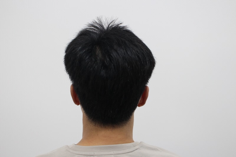 2[크기변환]수술후 뒷모습-숱감소 없게 잘 뽑아주심.jpg