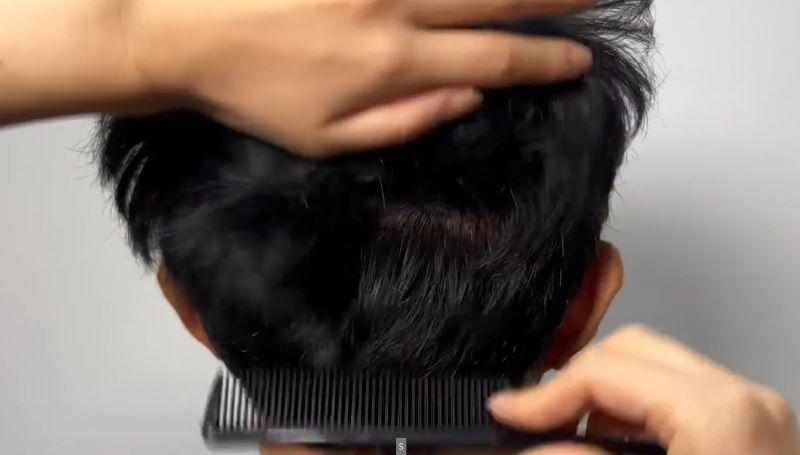 大田 リーズモ M字 ヘアライン 1500毛 毛髪移植 2日目 レビュー