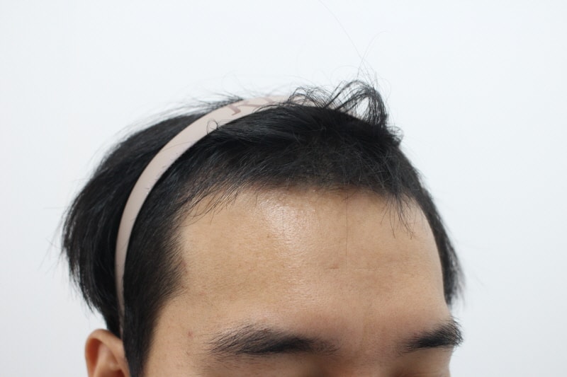 2[크기변환]160일차 암흑기가 지나고 모발이 나오기 시작합니다.jpg