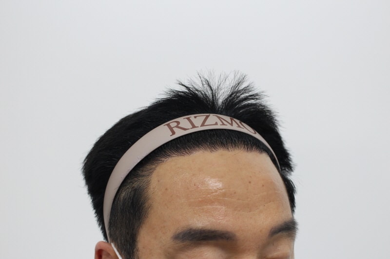 2[크기변환]수술후 240일차.jpg