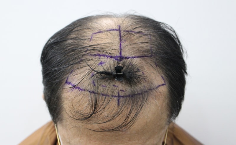 It's a 6 month review of mzar hair loss.