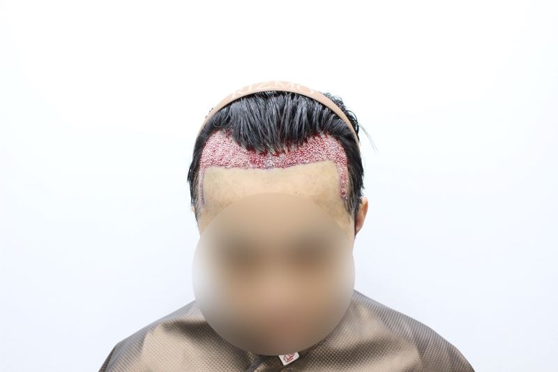 2 원하는라인으로 리즈모의원 원장님께서 고려해주셨습니다. 충분한 상담을 하고 수술당일 더 정밀하게 디자인해주셨습니다. .jpg