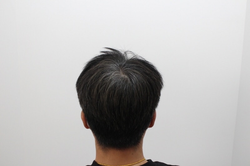 2[크기변환]뒤 정수리 부위도 굉장히 좋아졌습니다.jpg