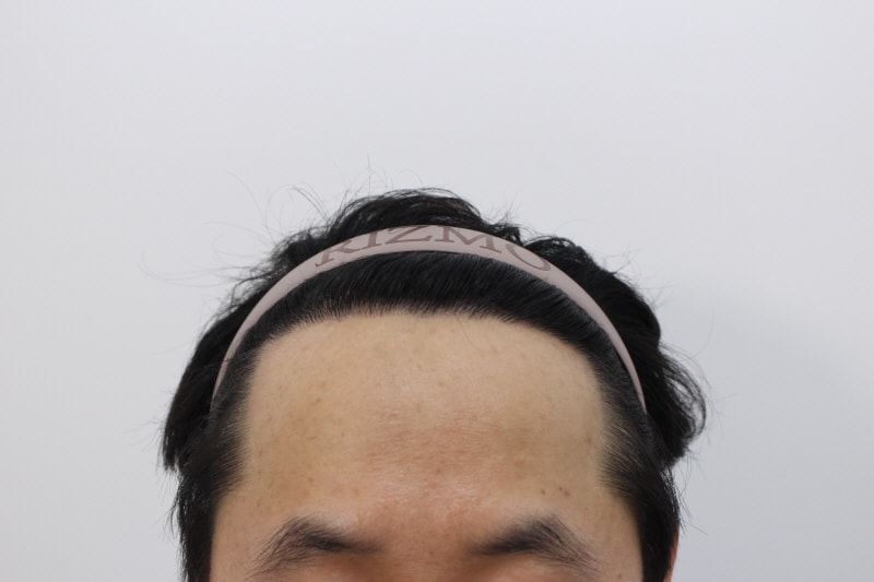 수술후 1년차.jpg