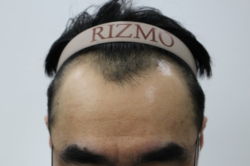 8-month review of male m-shaped hair transplantation