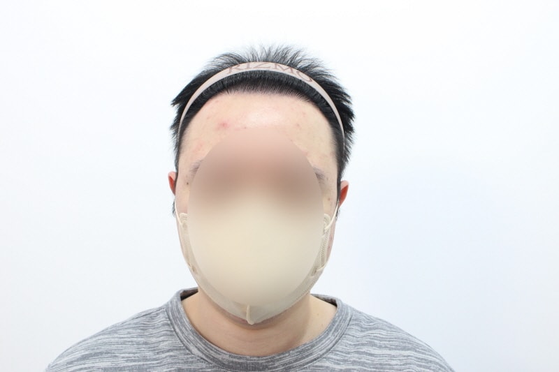 [크기변환]수술후 8개월d 2.jpg