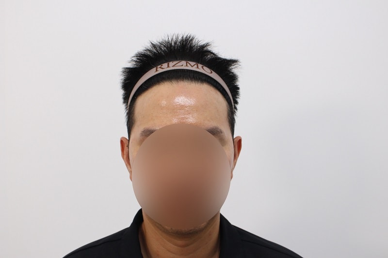 10. 수술후 8개월차 헤어라인.jpg