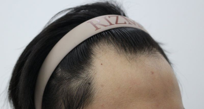 It's been two weeks since I had an M-shaped cut hair transplant!!!
